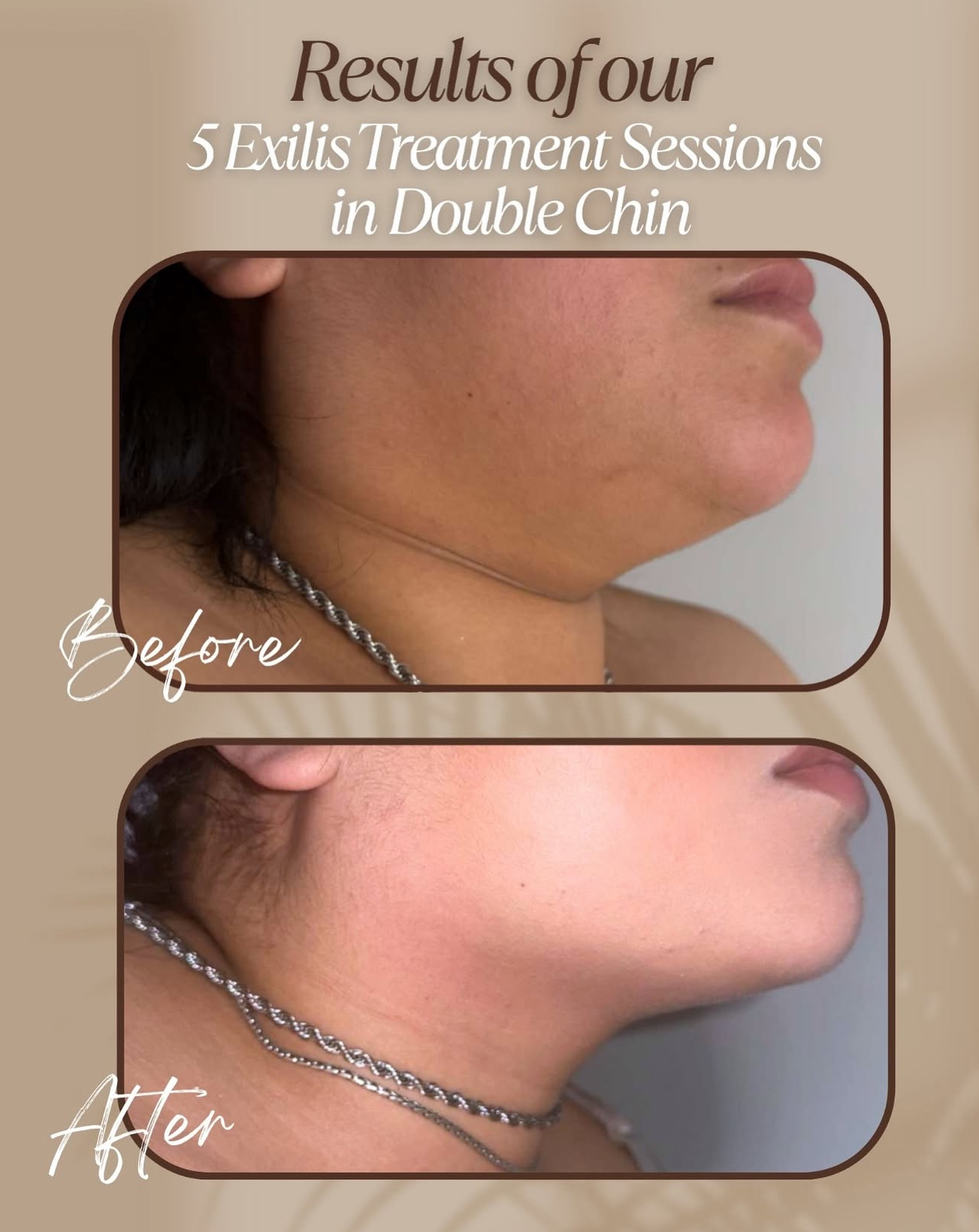 Comparison of double chin before and after Exilis treatment sessions, showing reduced chin fullness.