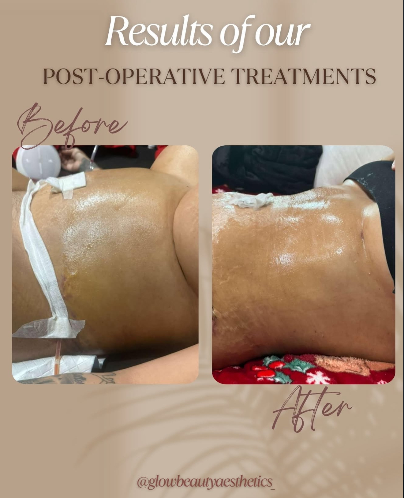 Comparison of back before and after post-operative treatments showing improved skin condition.