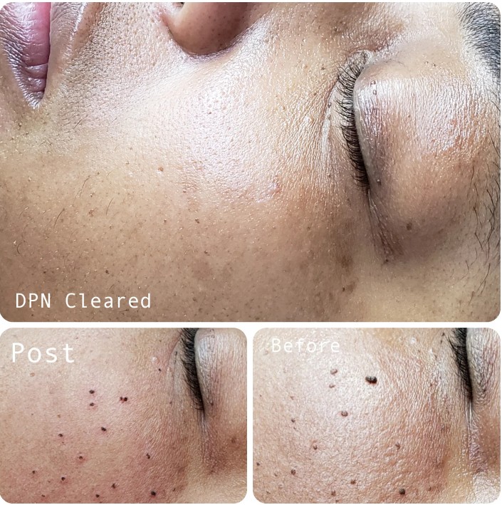 Close-up of a person's face showing skin before and after a treatment, with visible pores and small spots, eyes closed.