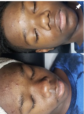Side-by-side close-up of a person's face with eyes closed, showing skin condition and facial features, wearing a blue shirt.