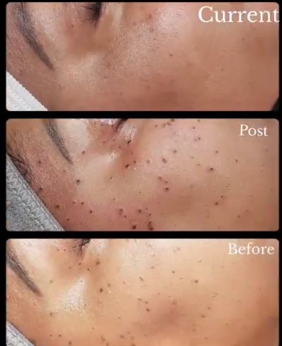 Comparison of skin before, during, and after treatment showing reduction in acne and blemishes.