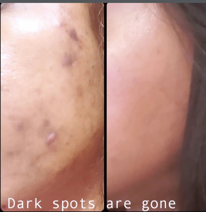 Side-by-side comparison of skin with dark spots before and after treatment, showing improvement. Word count: 20, confidence: 0.9
