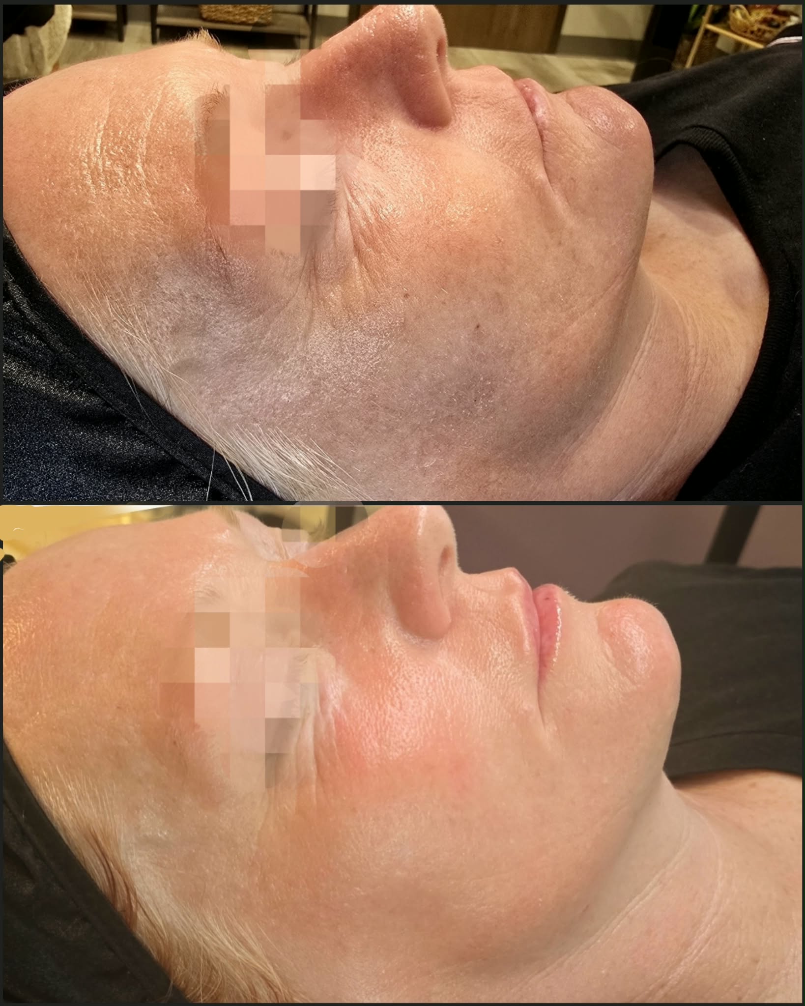 Side view of a woman's face before and after skincare treatment, showing skin improvement and redness reduction.