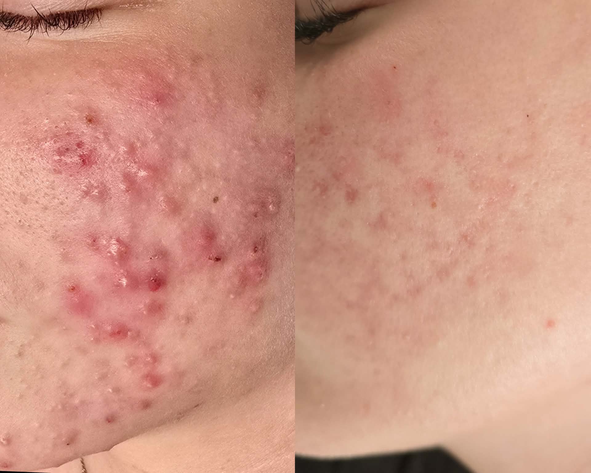 Comparison of skin with acne scars and clearer skin, showing reduction in redness and blemishes.