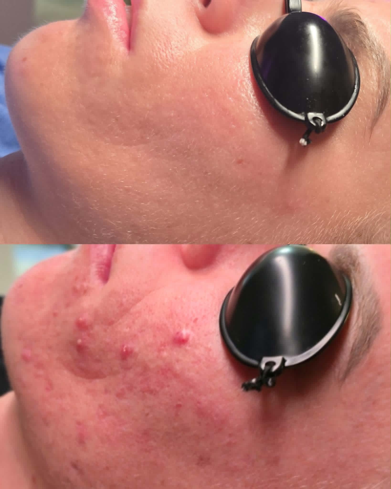Close-up of a person's face with skin irritation and acne, wearing protective goggles, side view.
