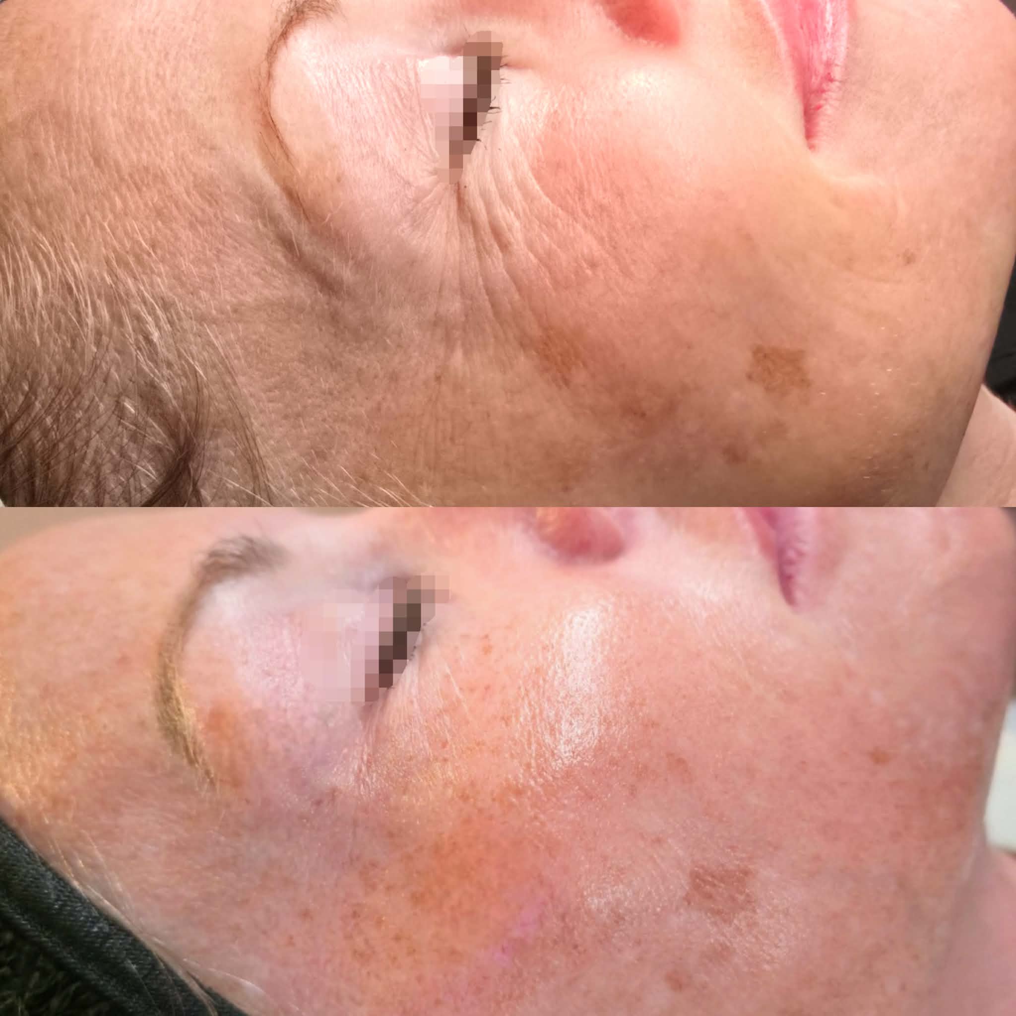 Close-up of a person's face before and after skincare, showing improved skin texture and pigmentation, with visible eye and cheek area.