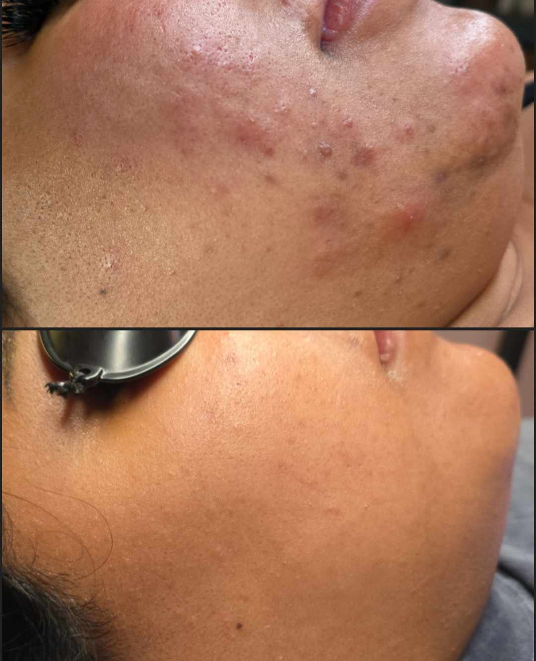 Comparison of skin before and after treatment, showing reduced acne scars and smoother skin surface.