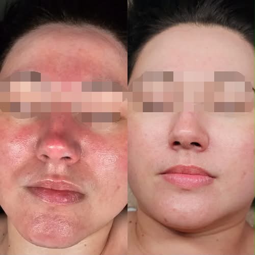 Side-by-side comparison of a person's face before and after skincare treatment, showing significant improvement in skin condition.