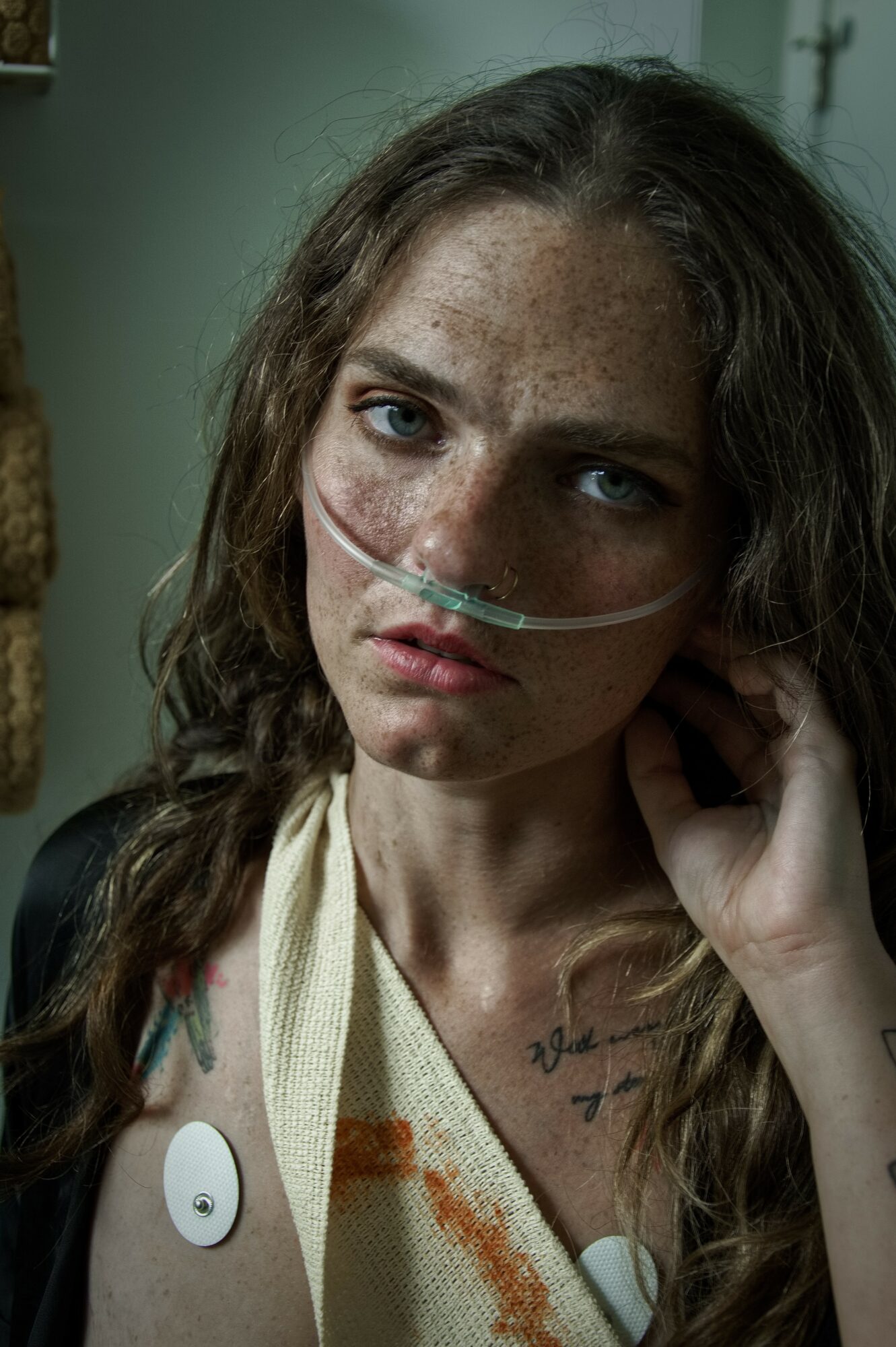 Young woman with freckles and blue eyes, wearing a nasal oxygen tube, looking at the camera, in a hospital setting.