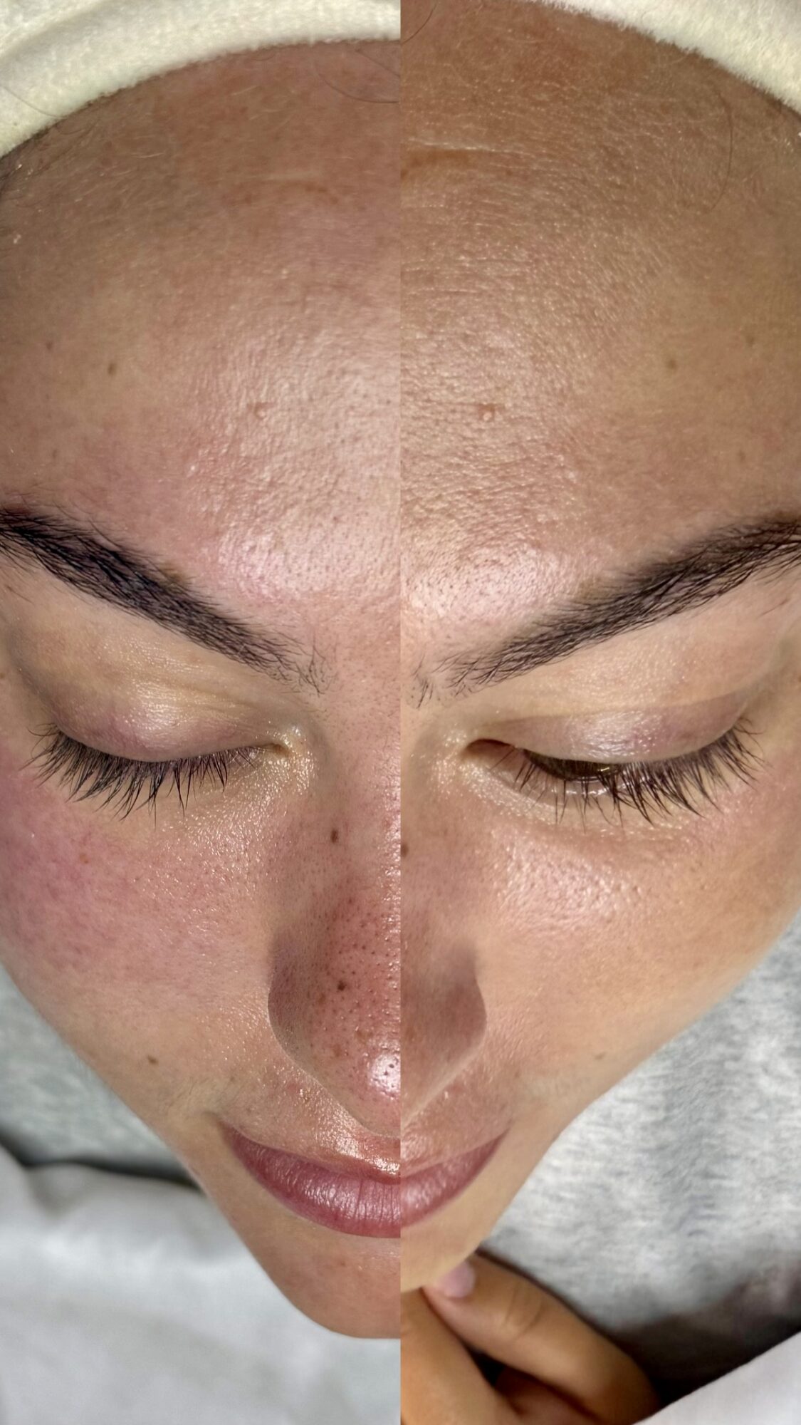 Close-up of a person's face showing skin with uneven texture and pigmentation, eyes closed, head tilted downward.