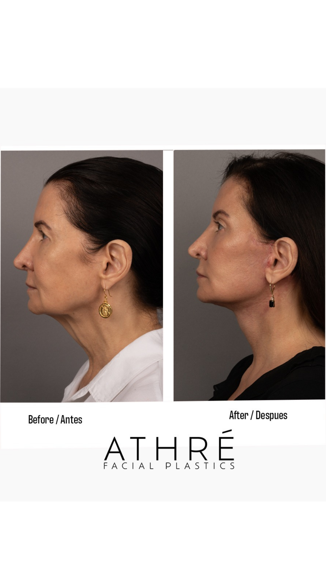 Side-by-side comparison of a woman's face before and after facial treatment, showing improved skin and contour, with a neutral background.