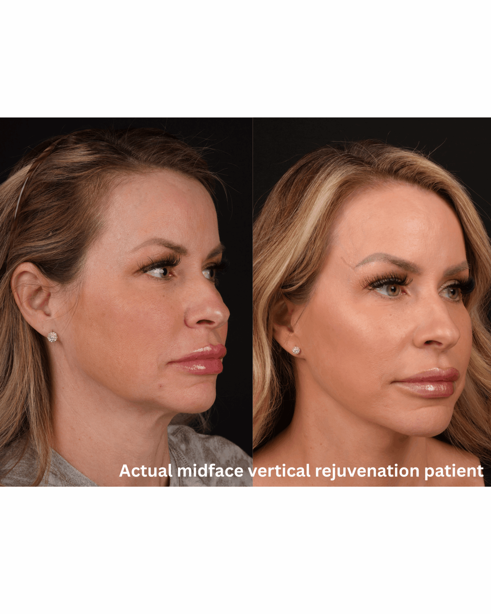 Side-by-side comparison of a woman's face before and after midface vertical rejuvenation, showing improved facial contours.