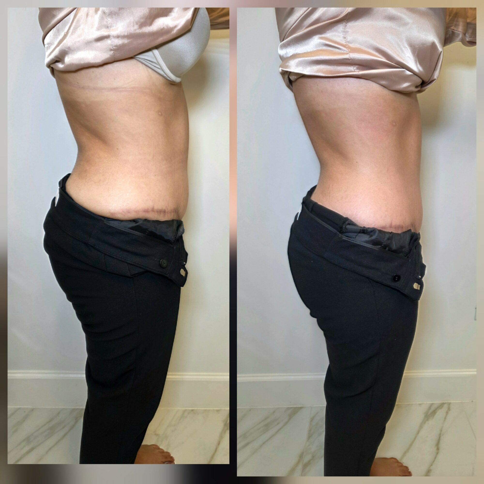 Side view of a person's waist and hips before and after weight loss, showing reduced abdominal size.