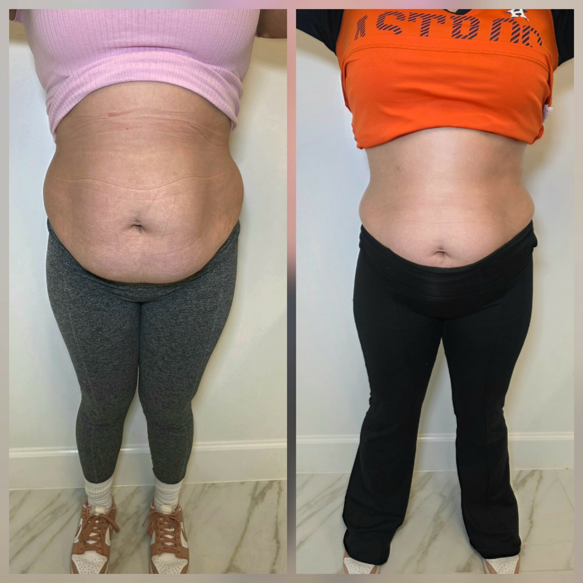 Side-by-side comparison of a person's abdomen before and after weight loss, showing reduced belly size and skin changes.