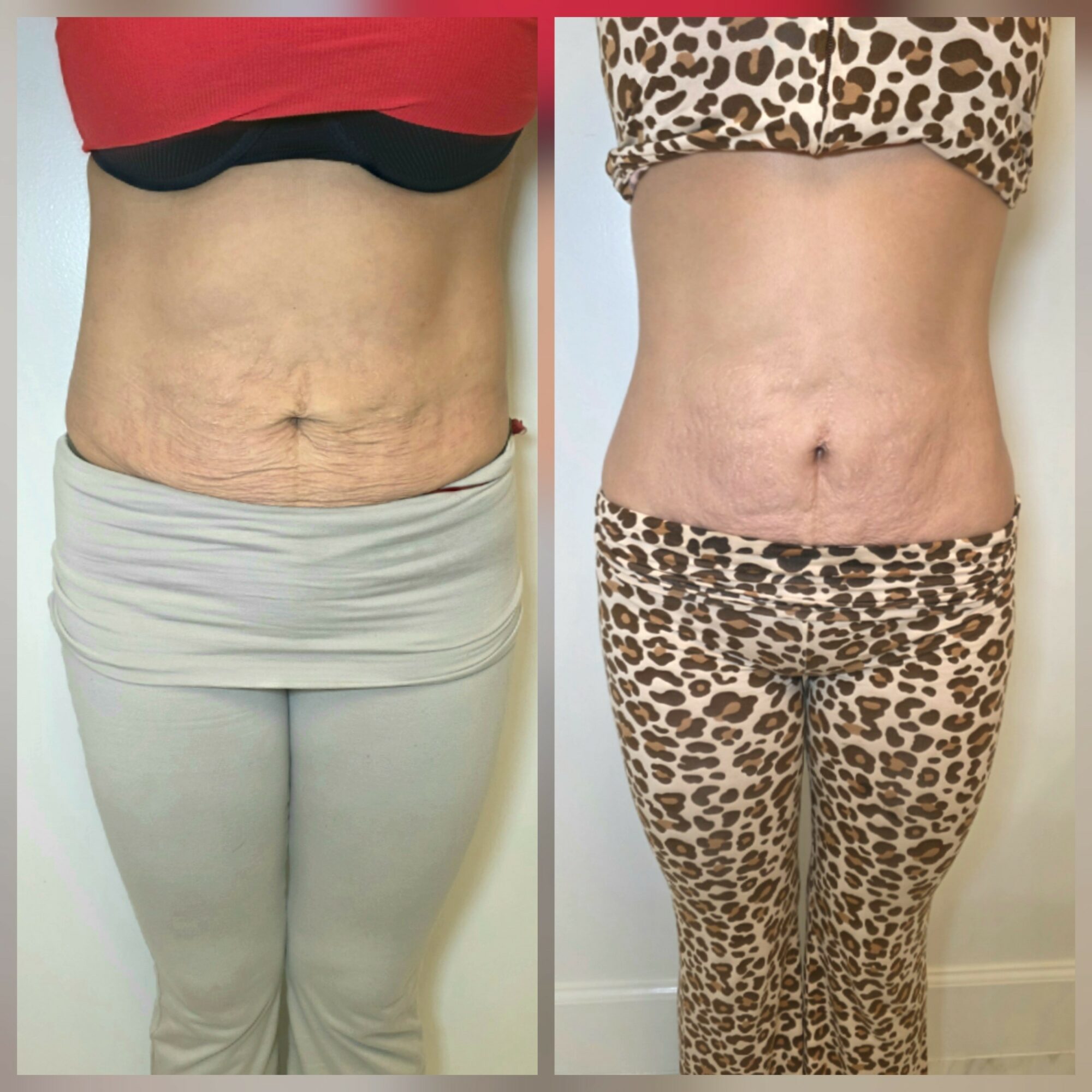 Comparison of a person's abdomen before and after a transformation, showing loose skin and a more toned appearance, wearing different outfits.