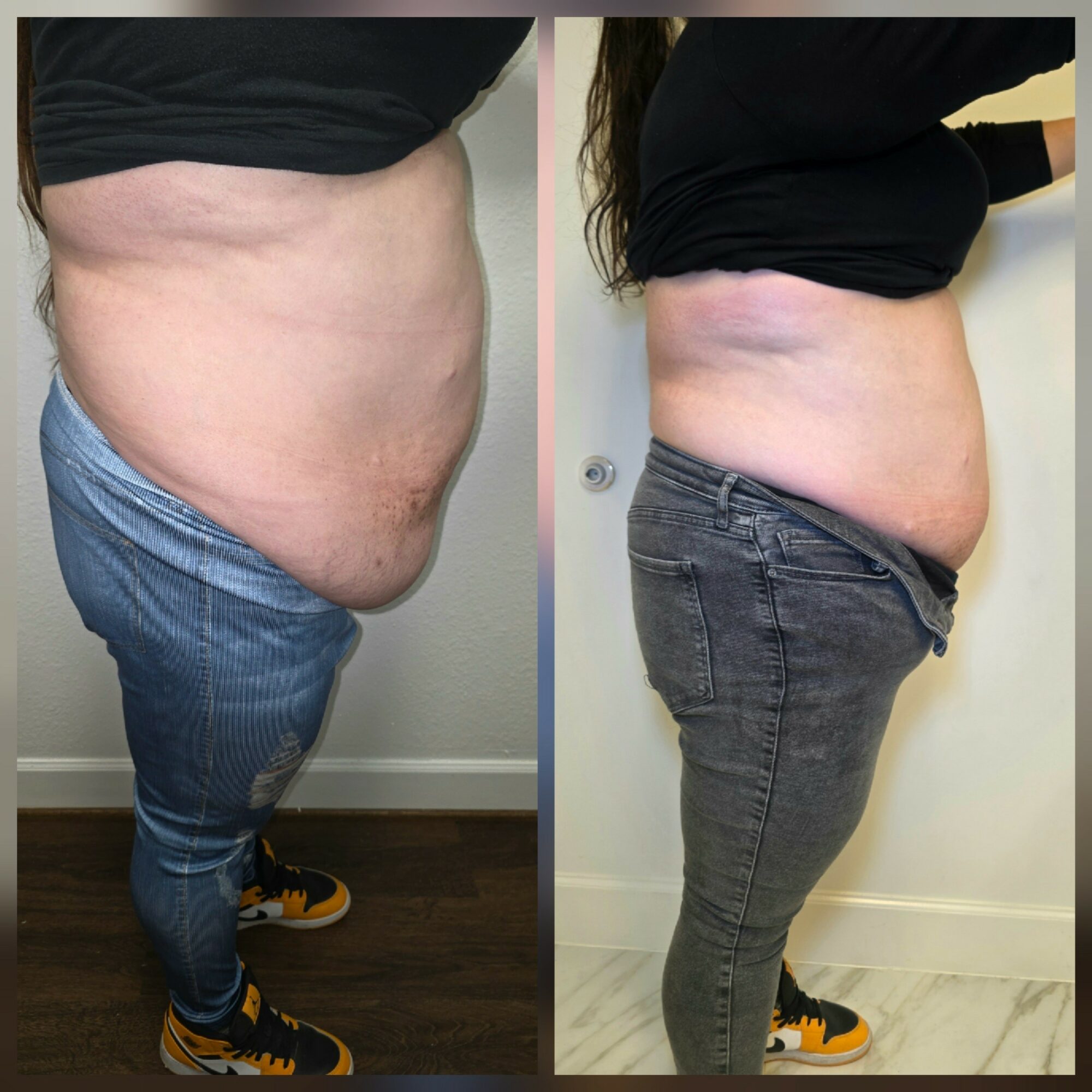 Side-by-side comparison of a person's abdomen before and after weight loss, showing reduced size and improved skin appearance.